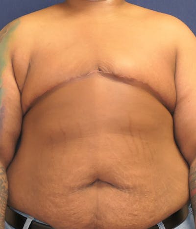 Masculinizing Surgery Before & After Gallery - Patient 326271 - Image 2