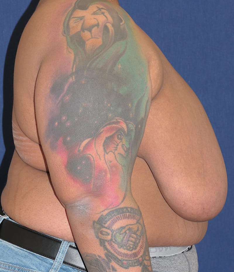 Masculinizing Surgery Before & After Gallery - Patient 326271 - Image 3