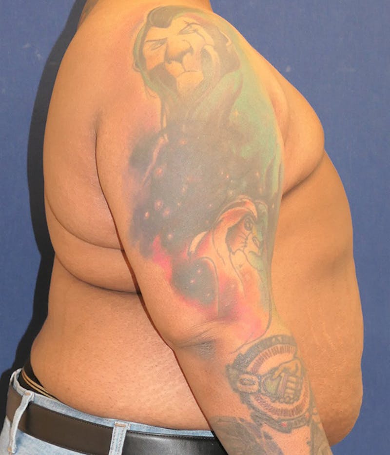 Masculinizing Surgery Before & After Gallery - Patient 326271 - Image 4
