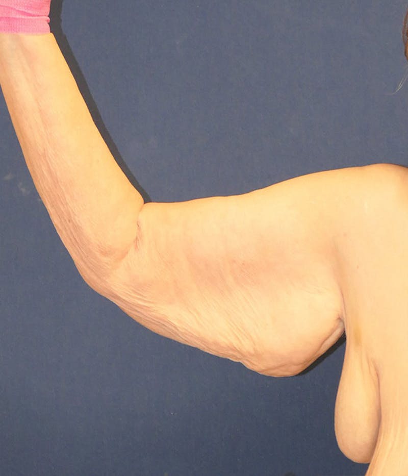 Arm Lift (Brachioplasty) Before & After Gallery - Patient 213701 - Image 5