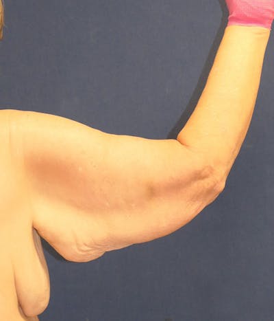 Arm Lift (Brachioplasty) Before & After Gallery - Patient 213701 - Image 1