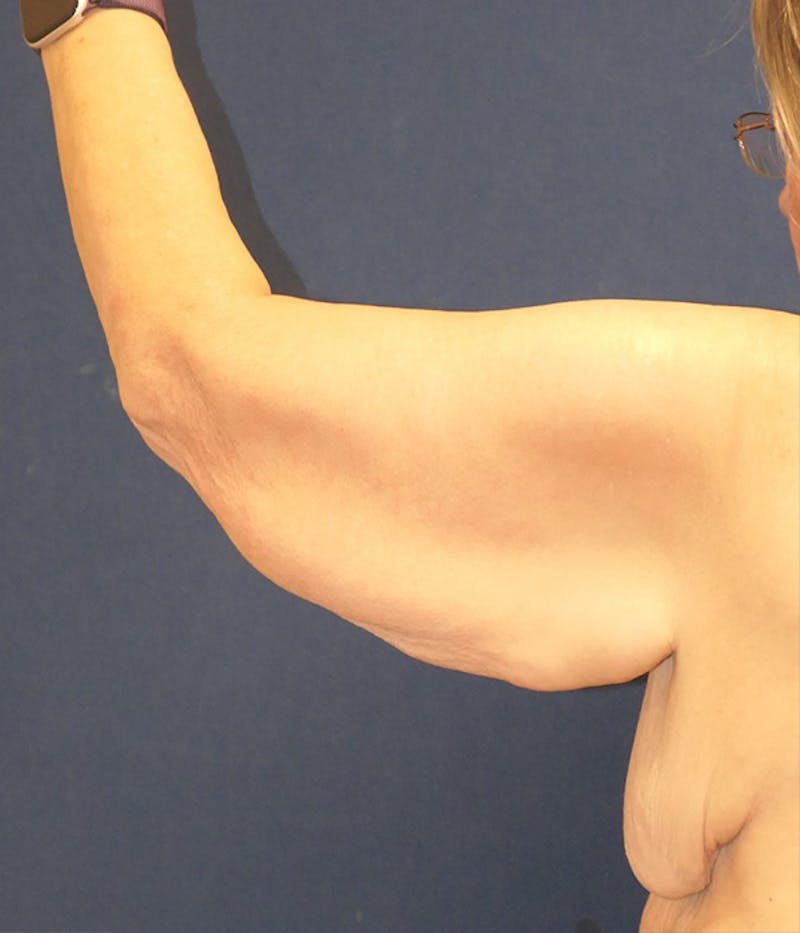 Arm Lift (Brachioplasty) Before & After Gallery - Patient 213701 - Image 7