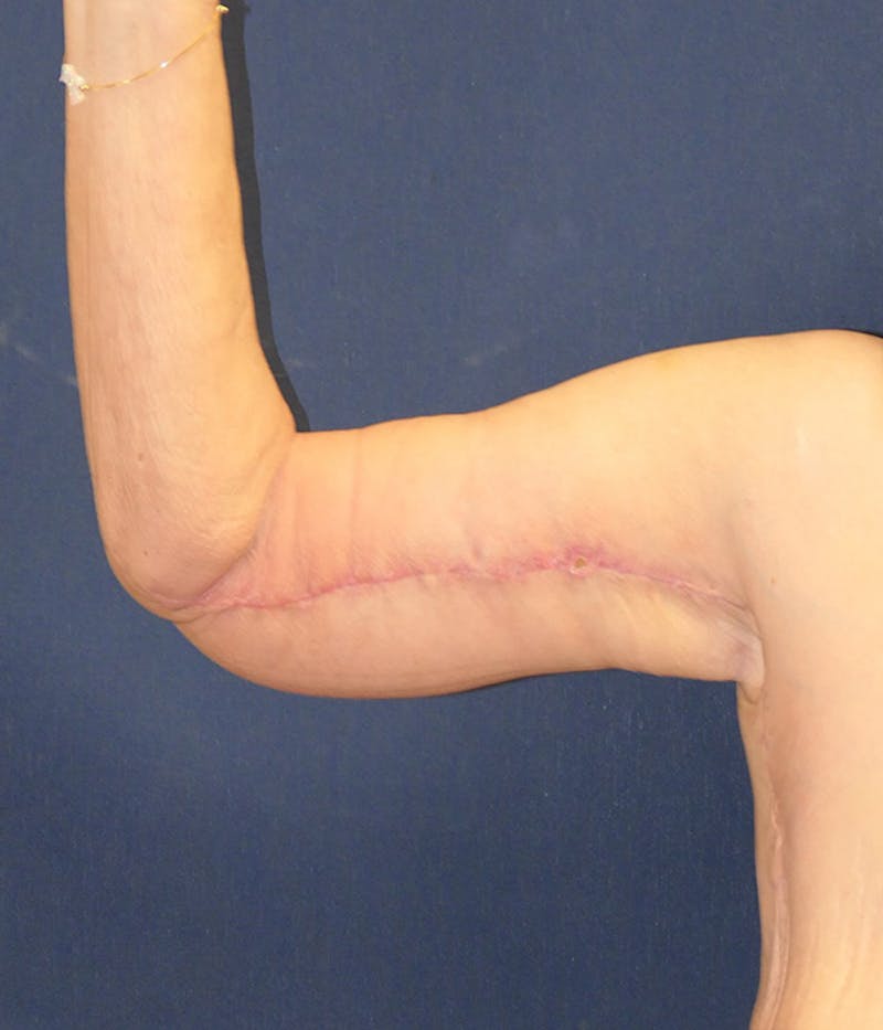 Arm Lift (Brachioplasty) Before & After Gallery - Patient 213701 - Image 8
