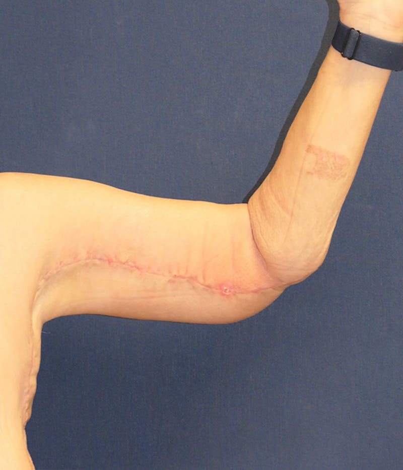 Arm Lift (Brachioplasty) Before & After Gallery - Patient 213701 - Image 4