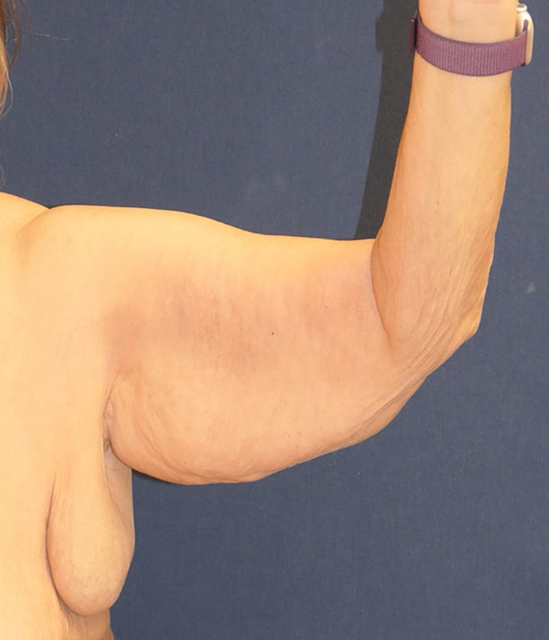 Arm Lift (Brachioplasty) Before & After Gallery - Patient 213701 - Image 3
