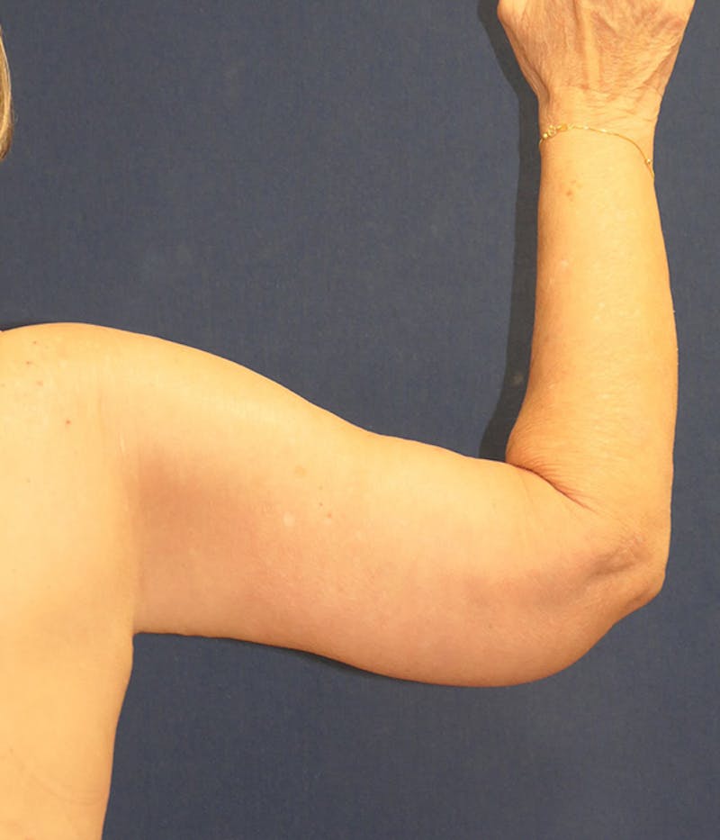 Arm Lift (Brachioplasty) Before & After Gallery - Patient 213701 - Image 2