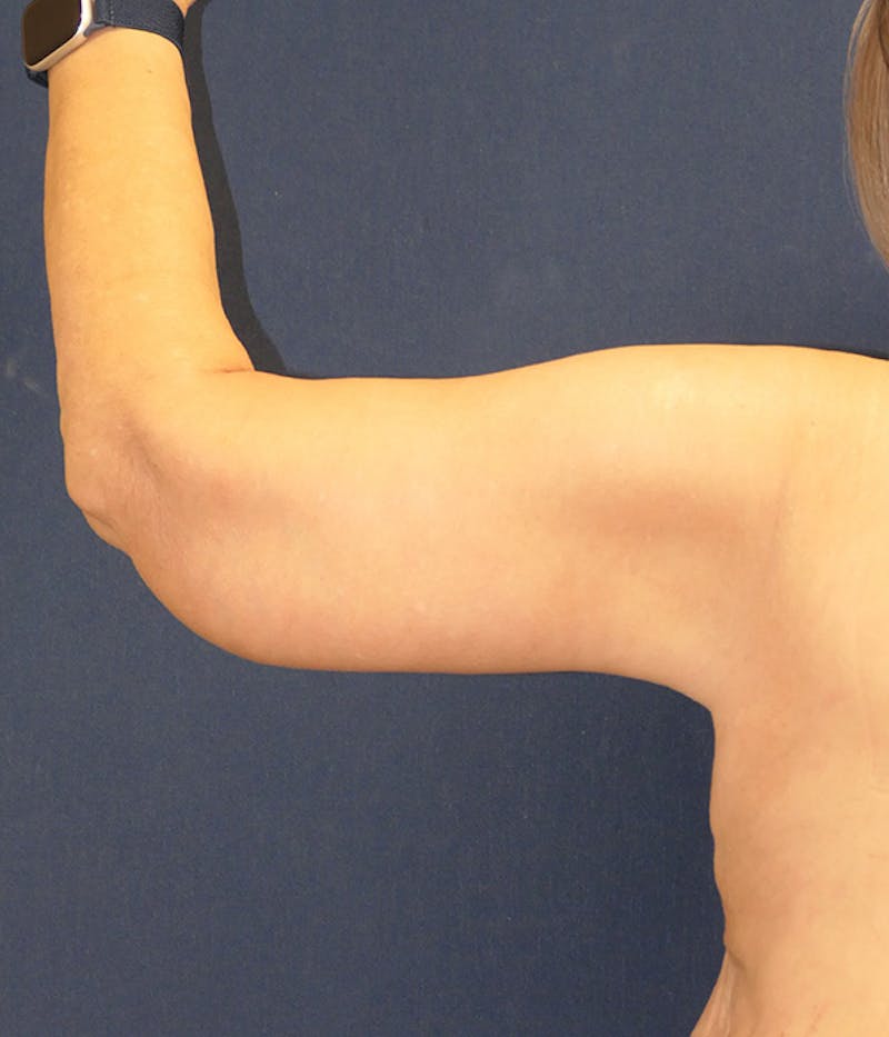 Arm Lift (Brachioplasty) Before & After Gallery - Patient 213701 - Image 6