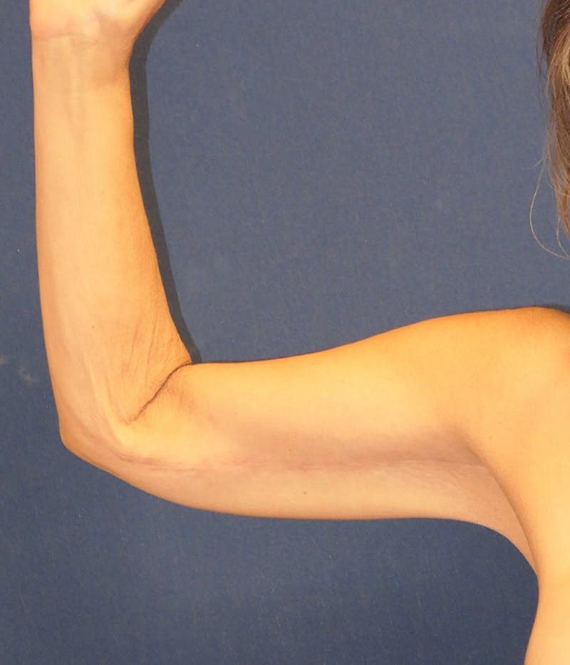 Arm Lift (Brachioplasty) Before & After Gallery - Patient 416632 - Image 2
