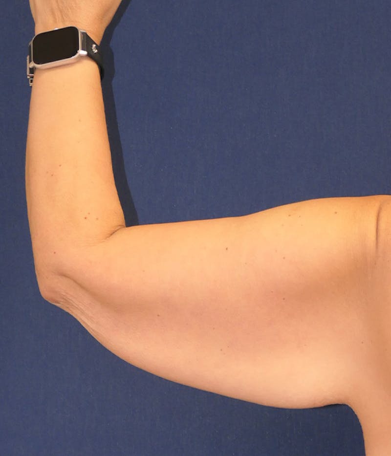 Arm Lift (Brachioplasty) Before & After Gallery - Patient 416632 - Image 7