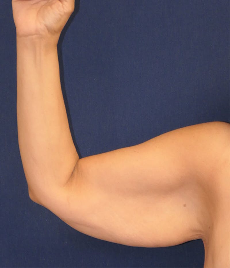 Arm Lift (Brachioplasty) Before & After Gallery - Patient 416632 - Image 1