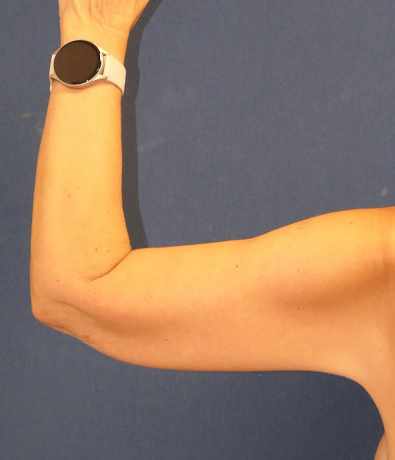 Arm Lift (Brachioplasty) Before & After Gallery - Patient 416632 - Image 8