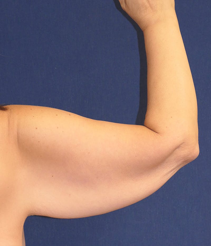 Arm Lift (Brachioplasty) Before & After Gallery - Patient 416632 - Image 5