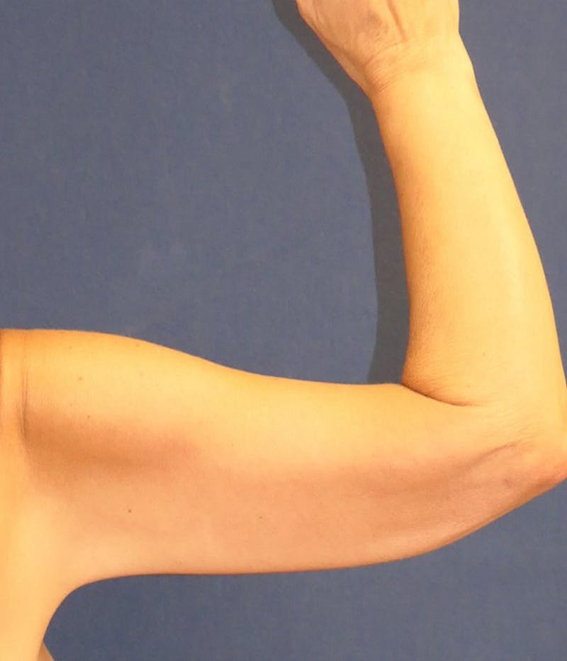Arm Lift (Brachioplasty) Before & After Gallery - Patient 416632 - Image 6