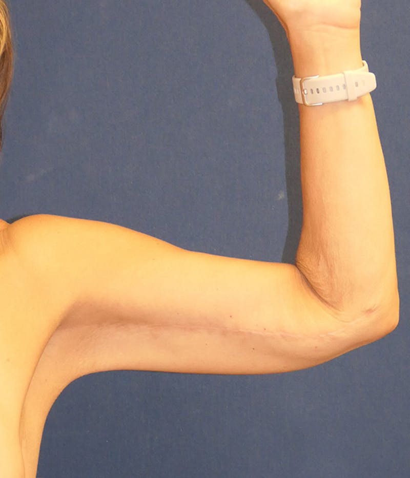 Arm Lift (Brachioplasty) Before & After Gallery - Patient 416632 - Image 4