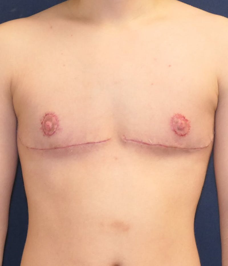 Masculinizing Surgery Before & After Gallery - Patient 114034 - Image 2