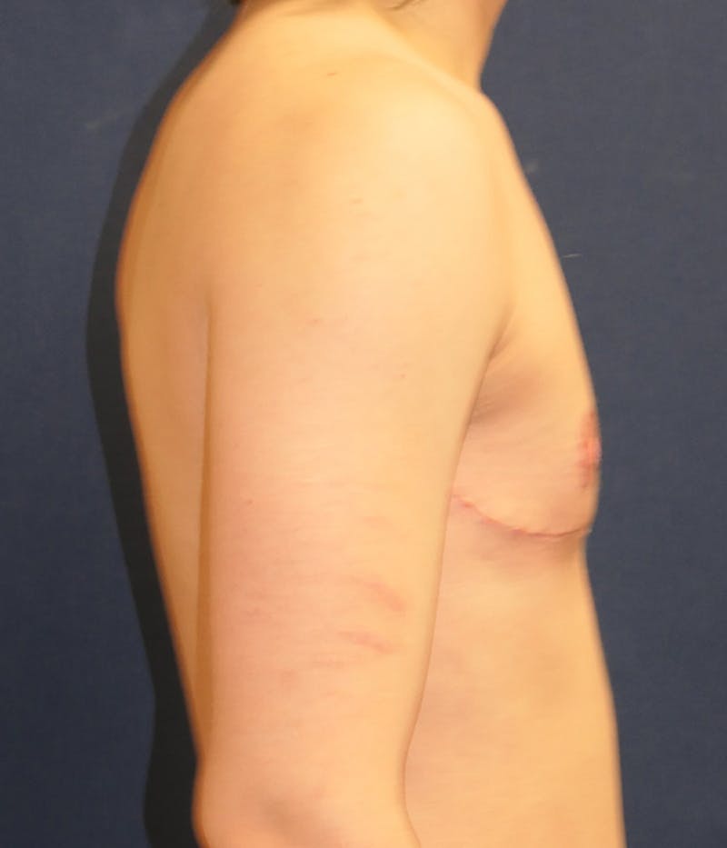 Masculinizing Surgery Before & After Gallery - Patient 114034 - Image 4