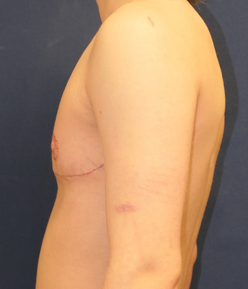 Masculinizing Surgery Before & After Gallery - Patient 114034 - Image 6