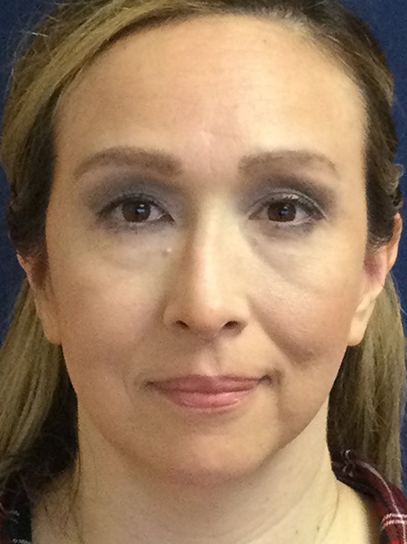 Facelift Before & After Gallery - Patient 293198 - Image 1
