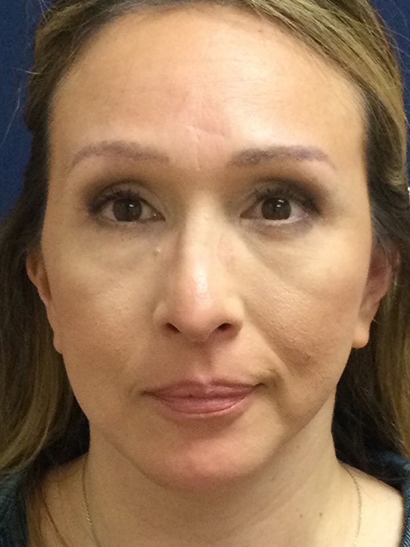 Facelift Before & After Gallery - Patient 293198 - Image 2