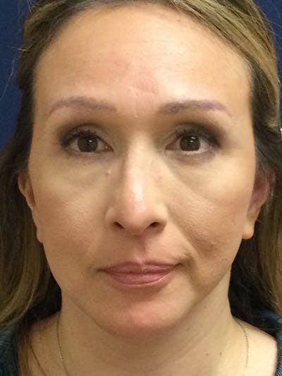 Facelift Before & After Gallery - Patient 293198 - Image 2