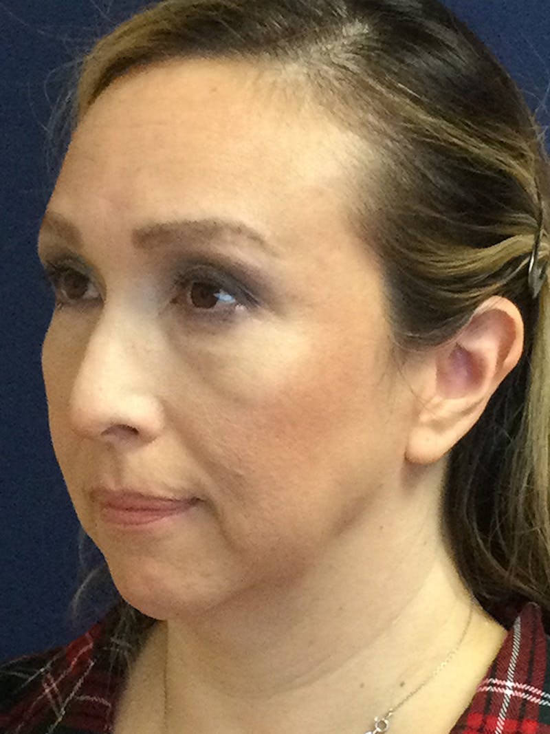 Facelift Before & After Gallery - Patient 293198 - Image 3