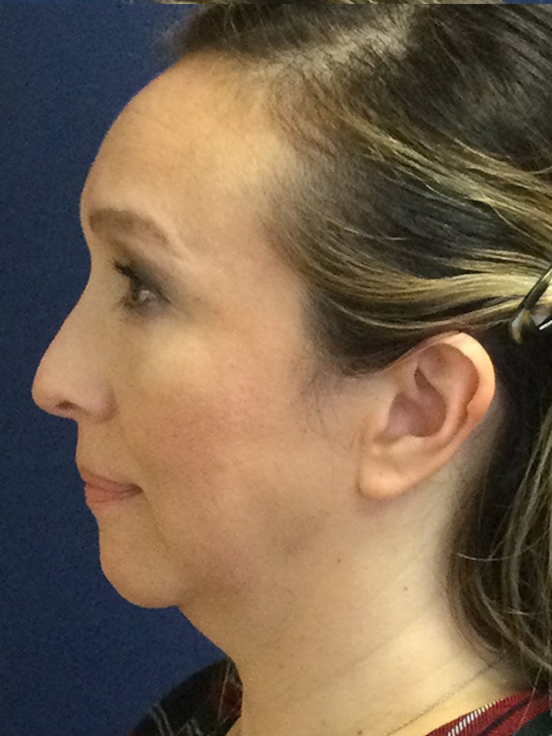 Facelift Before & After Gallery - Patient 293198 - Image 5