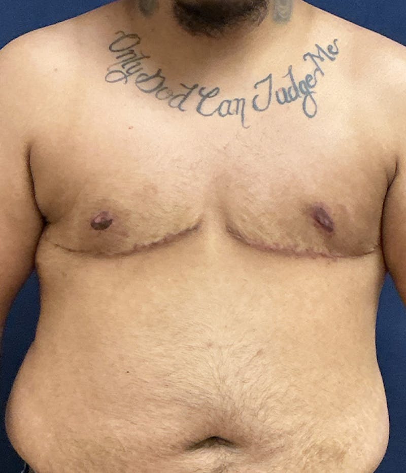 Masculinizing Surgery Before & After Gallery - Patient 186982 - Image 2