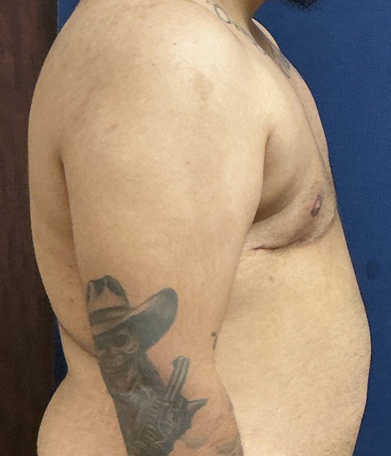 Masculinizing Surgery Before & After Gallery - Patient 186982 - Image 4