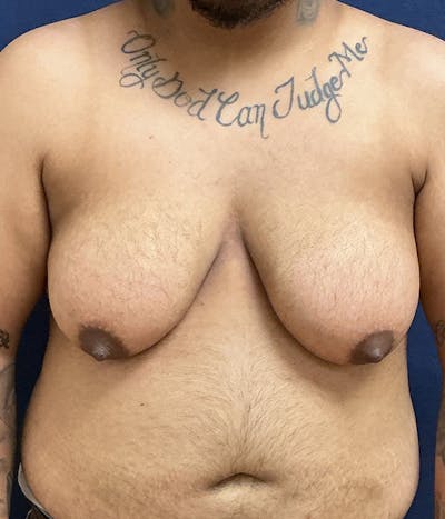 Masculinizing Surgery Before & After Gallery - Patient 186982 - Image 1