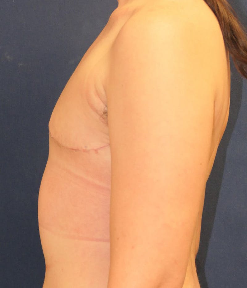 Masculinizing Surgery Before & After Gallery - Patient 861692 - Image 6