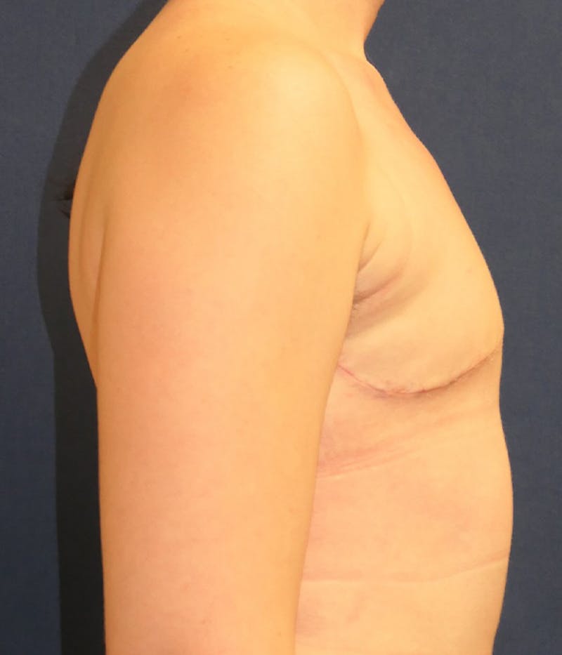 Masculinizing Surgery Before & After Gallery - Patient 861692 - Image 4