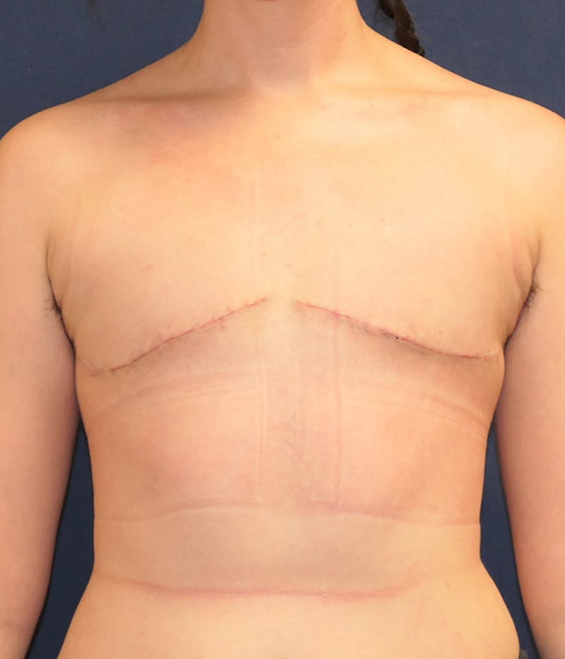 Masculinizing Surgery Before & After Gallery - Patient 861692 - Image 2