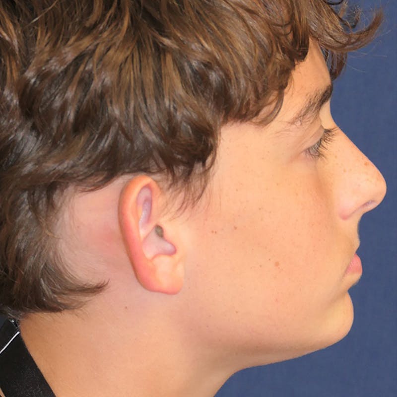Ear Pinning (Otoplasty) Before & After Gallery - Patient 280146 - Image 3