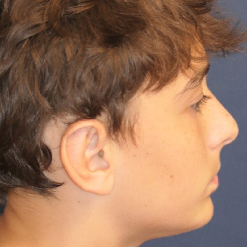 Ear Pinning (Otoplasty) Before & After Gallery - Patient 280146 - Image 4