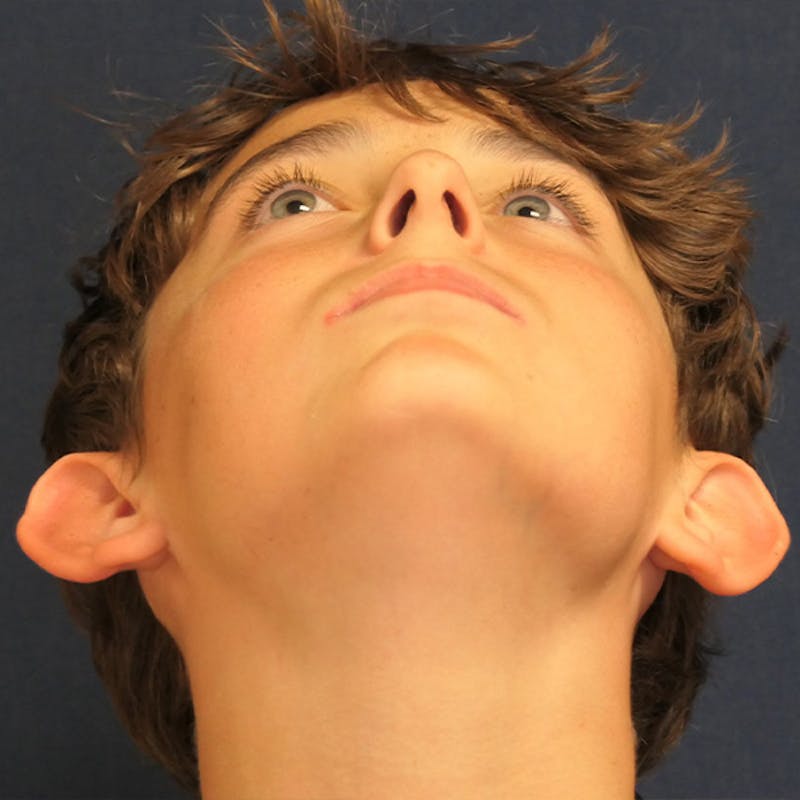 Ear Pinning (Otoplasty) Before & After Gallery - Patient 280146 - Image 8