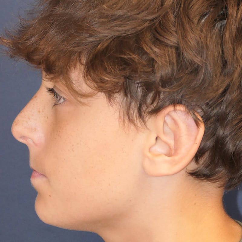 Ear Pinning (Otoplasty) Before & After Gallery - Patient 280146 - Image 6