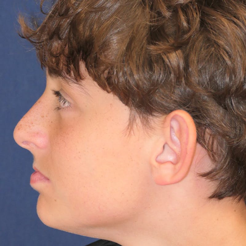 Ear Pinning (Otoplasty) Before & After Gallery - Patient 280146 - Image 5