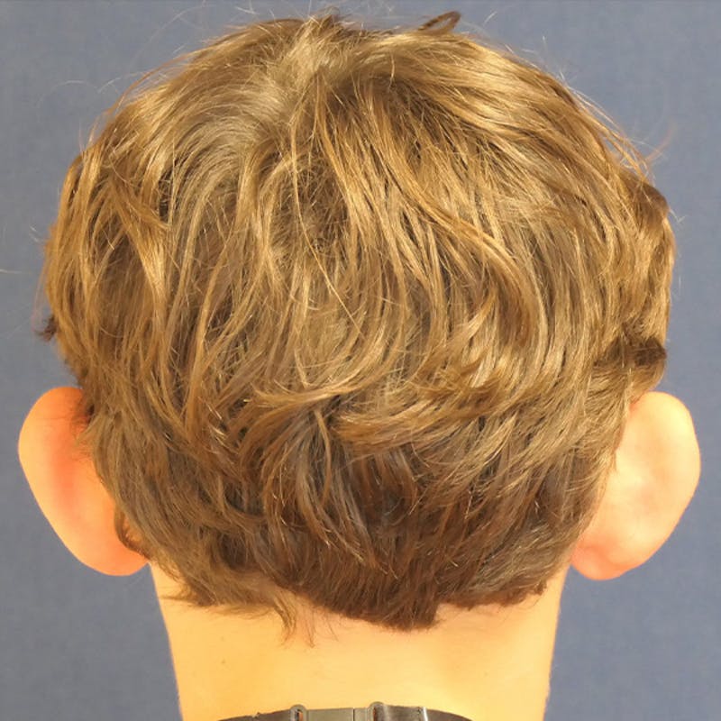 Ear Pinning (Otoplasty) Before & After Gallery - Patient 280146 - Image 9
