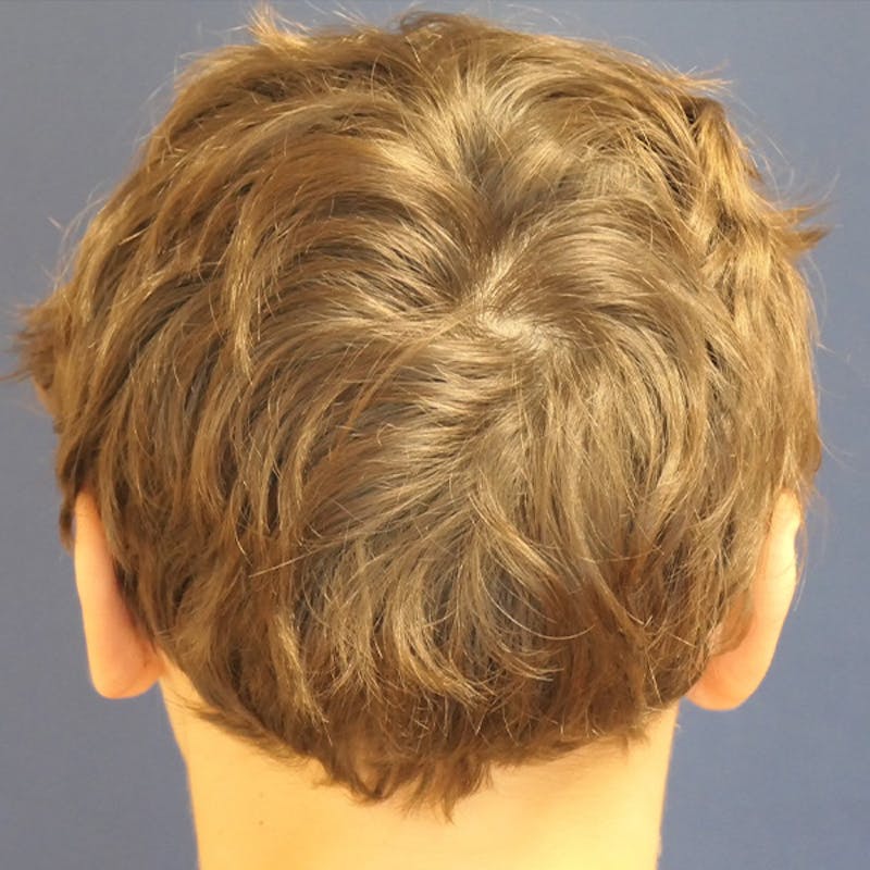 Ear Pinning (Otoplasty) Before & After Gallery - Patient 280146 - Image 10