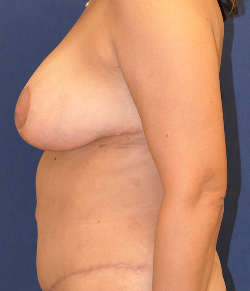 Breast Lift Before & After Gallery - Patient 735343 - Image 8