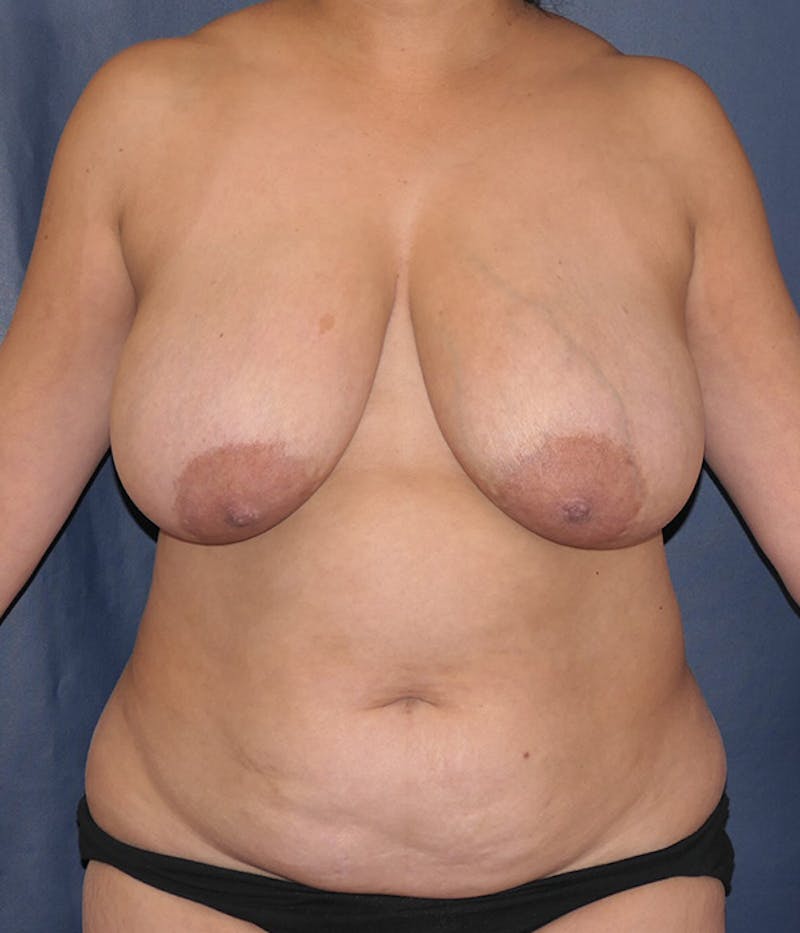 Breast Lift Before & After Gallery - Patient 735343 - Image 1
