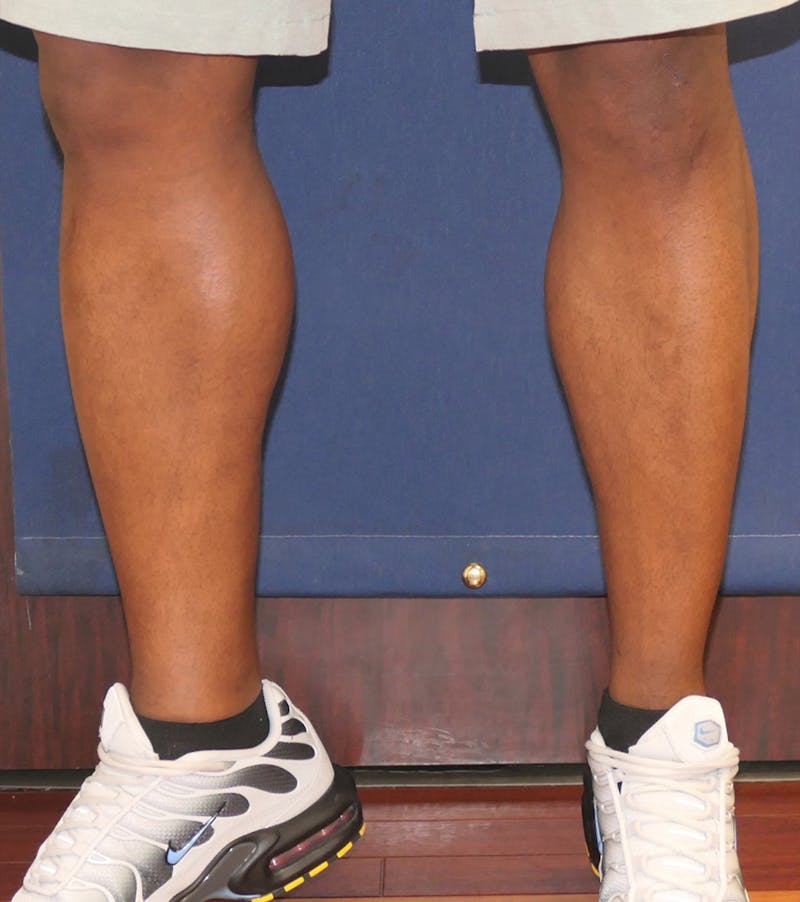 Calf Augmentation with Implants Before & After Gallery - Patient 420815 - Image 6