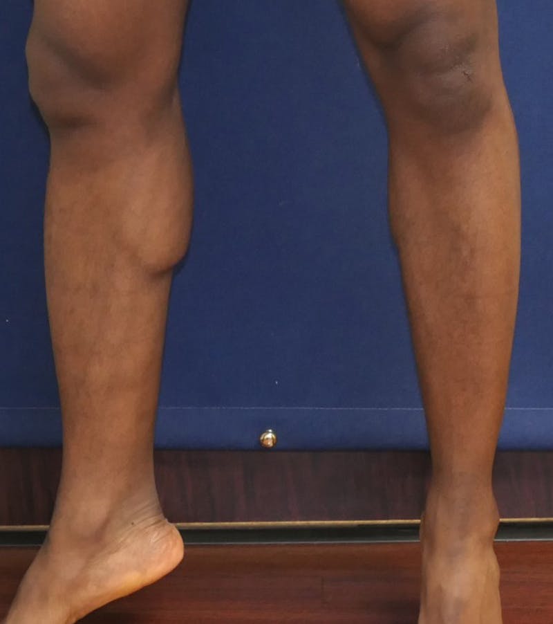 Calf Augmentation with Implants Before & After Gallery - Patient 420815 - Image 5
