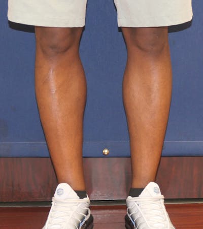 Calf Augmentation with Implants Before & After Gallery - Patient 420815 - Image 2
