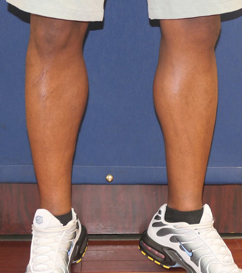 Calf Augmentation with Implants Before & After Gallery - Patient 420815 - Image 4