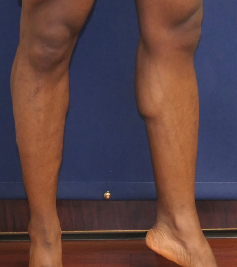 Calf Augmentation with Implants Before & After Gallery - Patient 420815 - Image 3