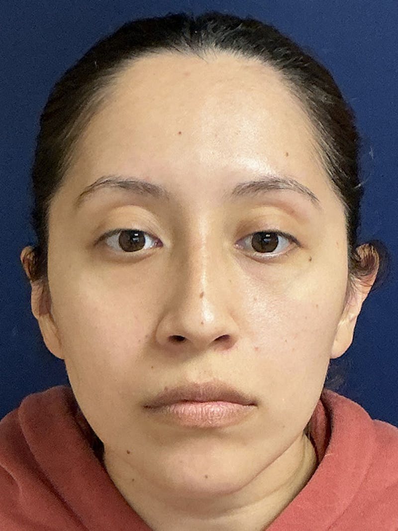 Feminizing Surgery Before & After Gallery - Patient 182872 - Image 1