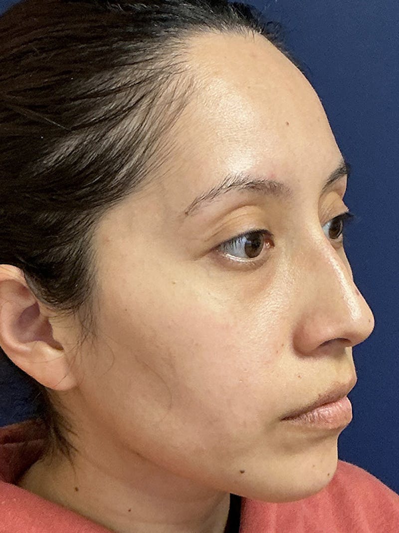 Feminizing Surgery Before & After Gallery - Patient 182872 - Image 3