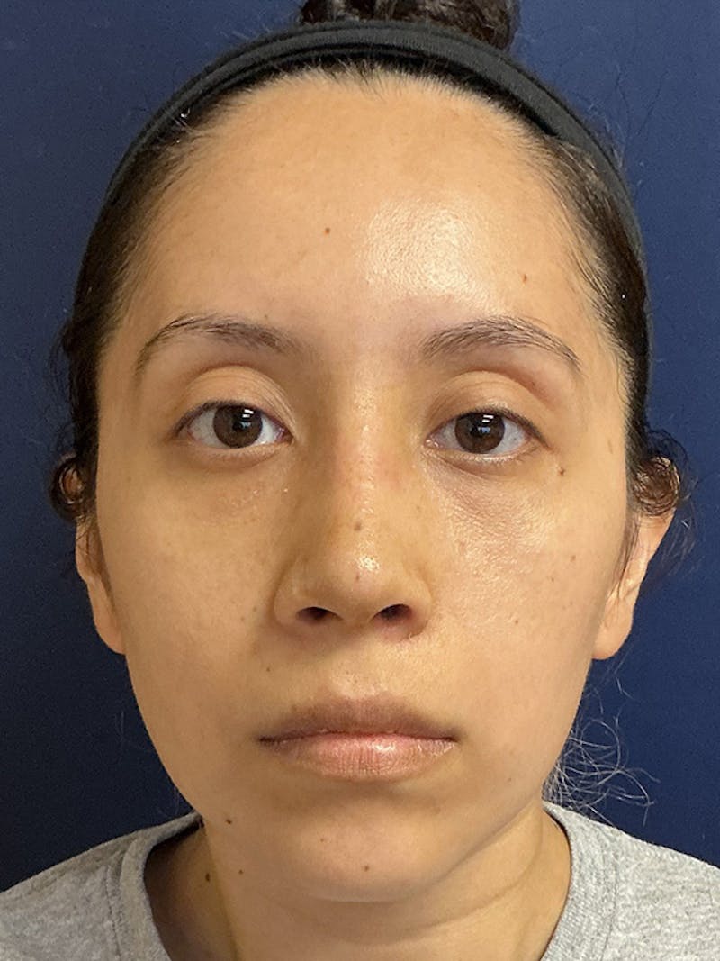 Feminizing Surgery Before & After Gallery - Patient 182872 - Image 2