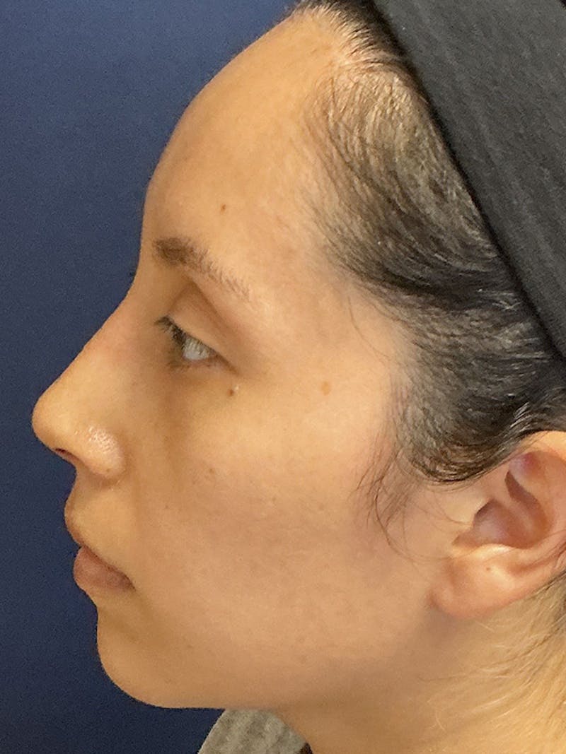 Feminizing Surgery Before & After Gallery - Patient 182872 - Image 10
